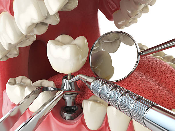 Best Emergency Root Canal Treatment in Farmington, MS